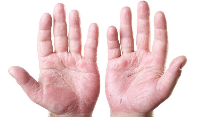 Трещины кожи рук