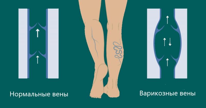 Варикозное расширение вен. Обострение хронического тромбофлебита