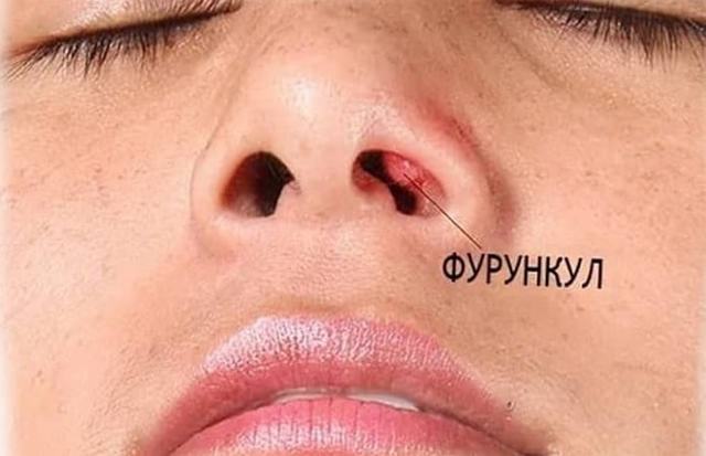 Фурункулы носа