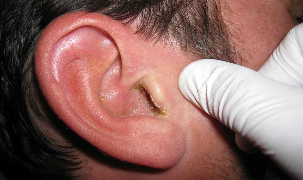 Разлитое воспаление кожи наружного слухового прохода