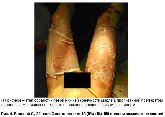 bolnoi-c-oghogom-1.jpg bolnoi-c-oghogom-1.jpg