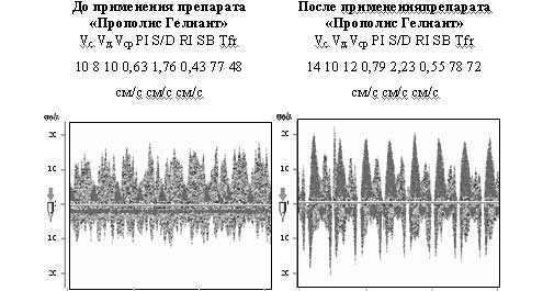 Варианты изменения допплерографии у пациентов с экземой до и после нанесения «Прополис Гелиант 10%»