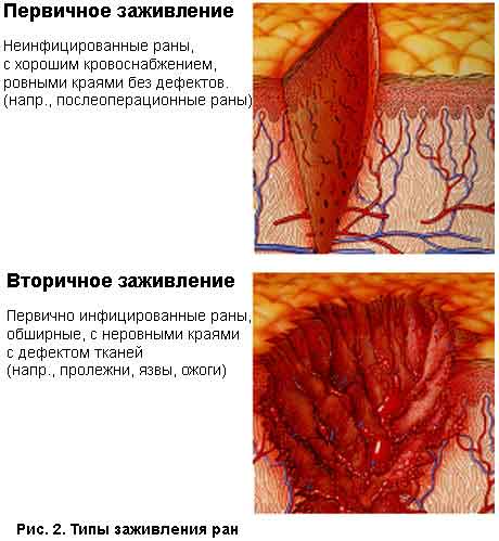 Pervichnoe-zaghivlenie.jpg